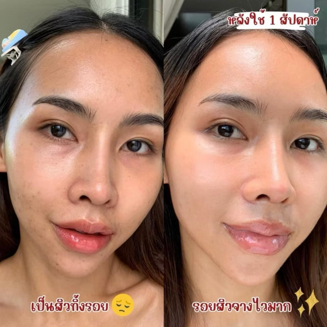 The Charming Garden Dragon's Blood Acne Scar 7g. (6 Sachets)
