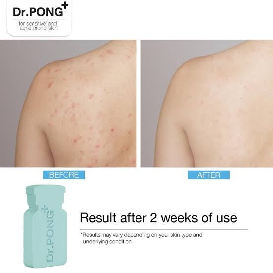 Dr. PONG Gentle Acne Care Soap 2 Bars