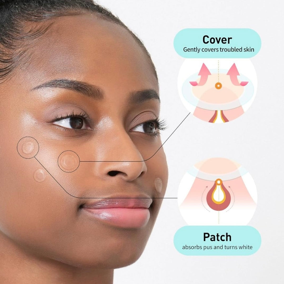 Korea’s #1 Olive Young acne patch — thin, invisible, long-lasting