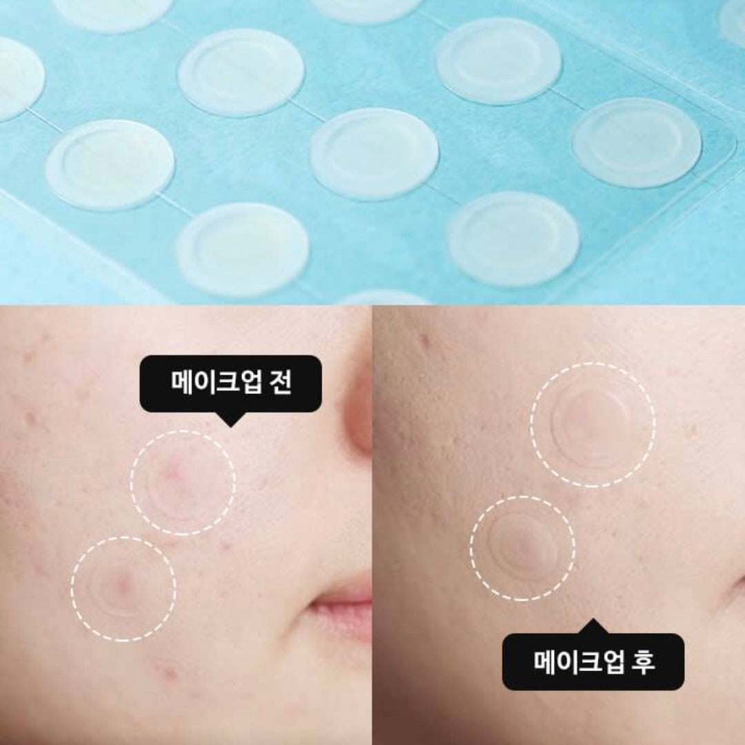 Korea’s #1 Olive Young acne patch — thin, invisible, long-lasting